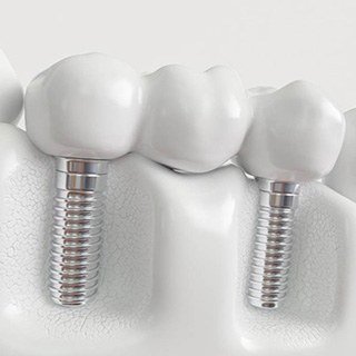 a 3D illustration of an implant dental bridge