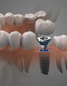 Digital illustration of a single tooth dental implant in Orange being placed