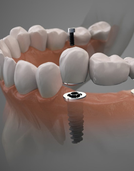 Digital illustration of an implant bridge replacing several missing teeth in Orange