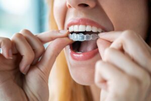 Nose to chin view of woman inserting Invisalign over top teeth