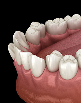 Illustration of crooked teeth