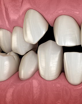 Illustration of spaced out teeth