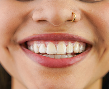 ClearCorrect aligners are much more comfortable than traditional braces
