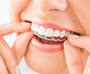 Discreet trays are one of the major benefits of ClearCorrect treatment