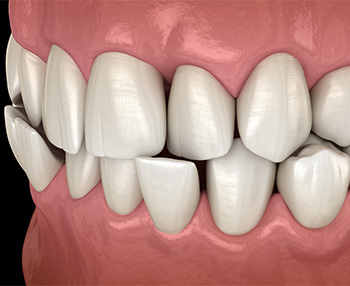 Illustration of a crossbite