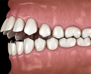 Illustration of an open bite