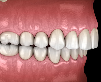 Illustration of an overbite