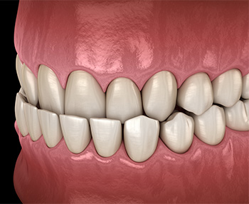 Illustration of an underbite