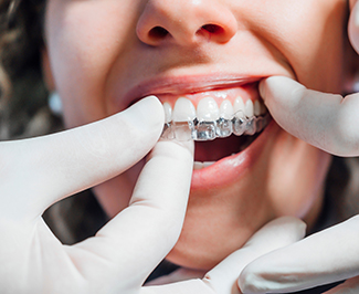 Dentist putting clear aligner on patient