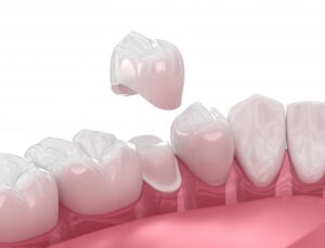 a 3D illustration of a dental crown