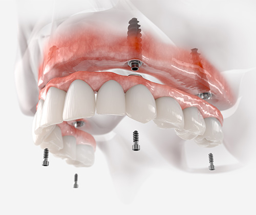A 3D illustration showing the implant denture process.