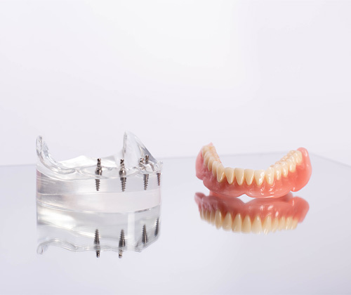 A close-up of implant dentures.